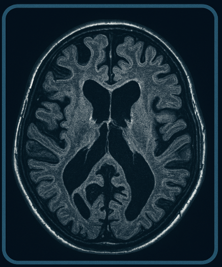 MRI Scan
